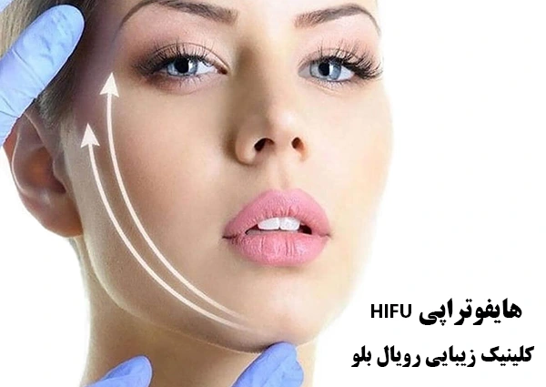 HIFU هایفو