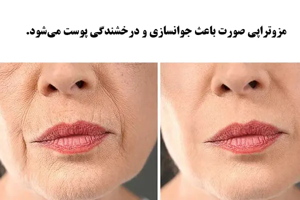 مزوتراپی صورت و پوست