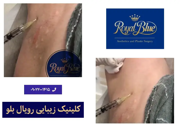 بوتاکس عرق زیر بغل