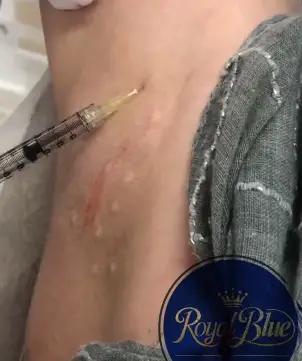 تزریق بوتاکس زیر بغل در تهران