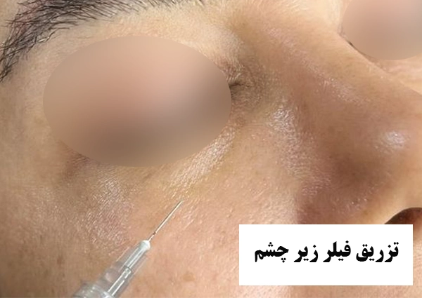 تزریق فیلر زیر چشم