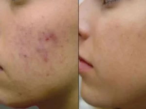 هایفو برای جای جوش