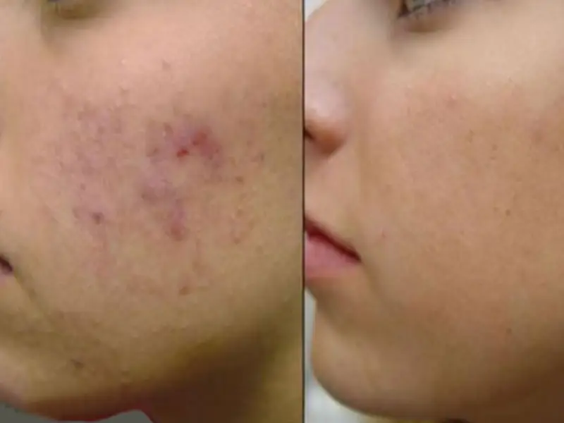 هایفو برای جای جوش