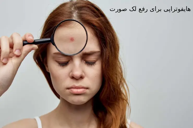 هایفو برای لک صورت