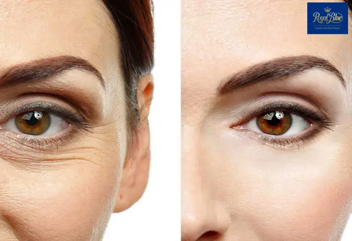 پلکسر صورت در تهران