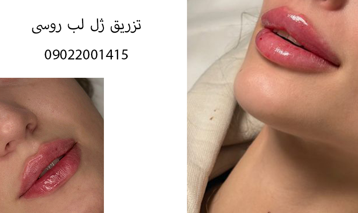 تزریق ژل لب روسی