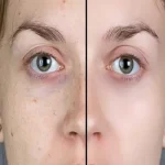 مزوتراپی رفع لک صورت