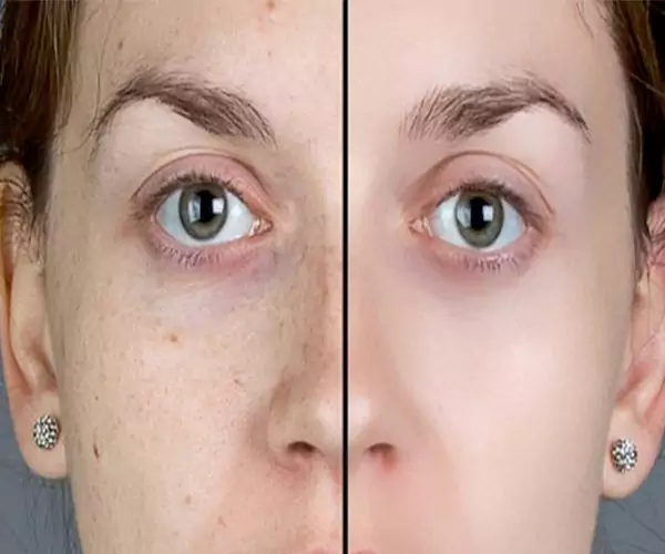 مزوتراپی رفع لک صورت