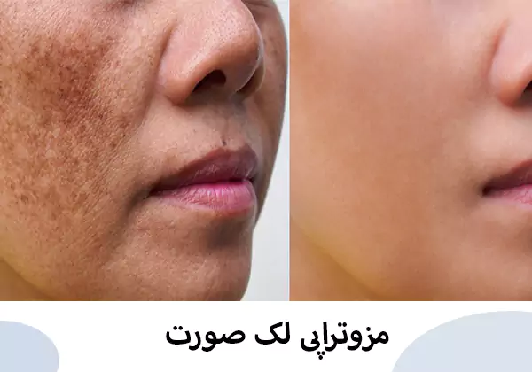 مزوتراپی لک صورت