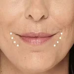 ژل خط ماریونت