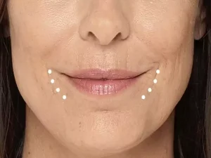 ژل خط ماریونت