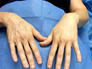 تزریق چربی به دست