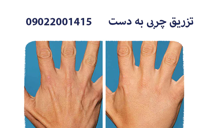 تزریق چربی به دست ها