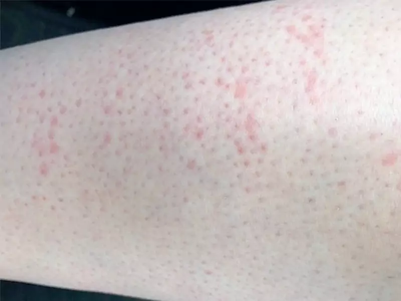 سوختگی با لیزر موی زائد