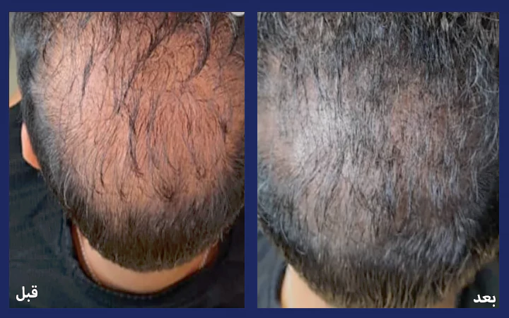عکس قبل و بعد مزوتراپی مو