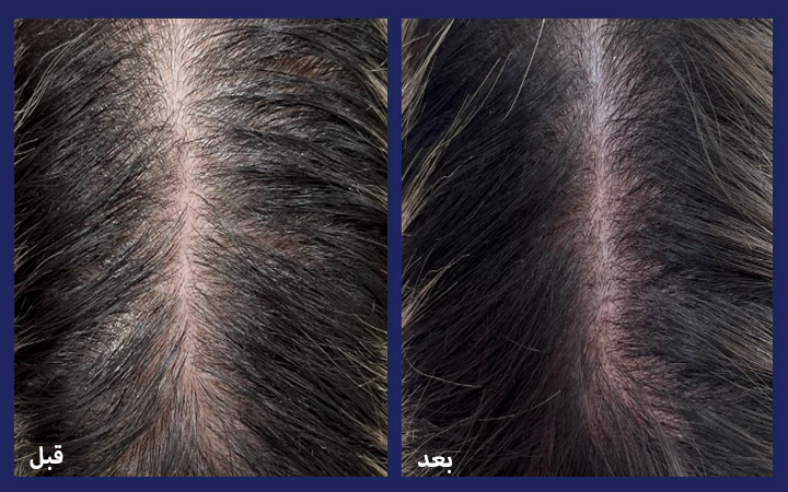 عکس واقعی مزوتراپی مو