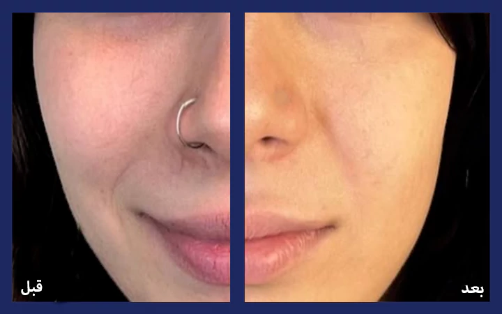 مزوتراپی صورت و تیرگی دور چشم