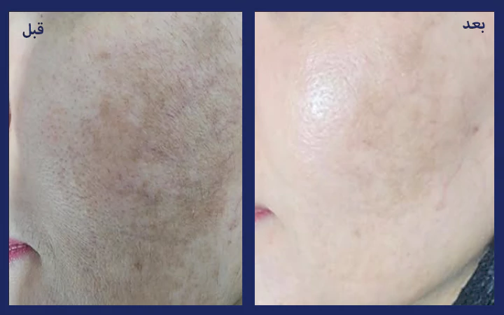 مزوتراپی لک صورت