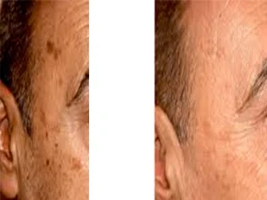 هایفوتراپی کک و مک