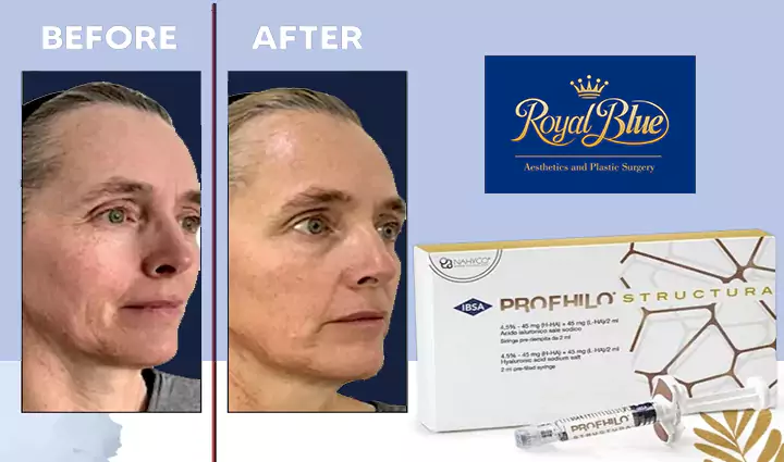 استراکچرا پروفایلو