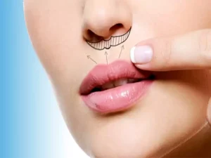 جراحی لیفت لب