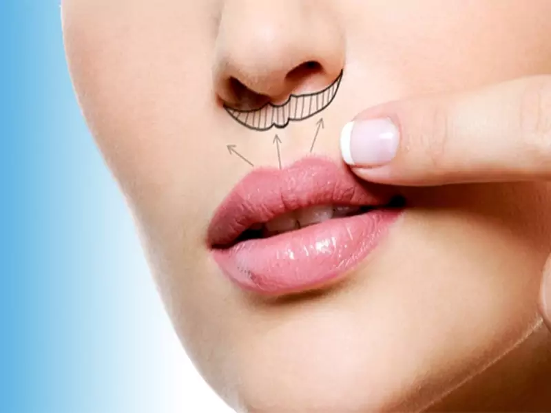 جراحی لیفت لب