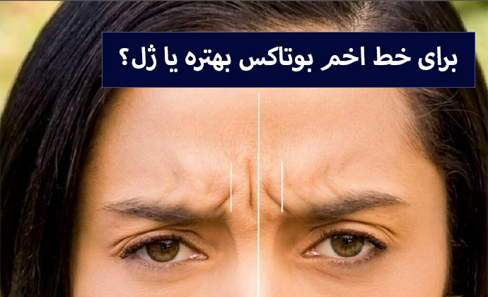 برای خط اخم بوتاکس بهتره یا ژل؟
